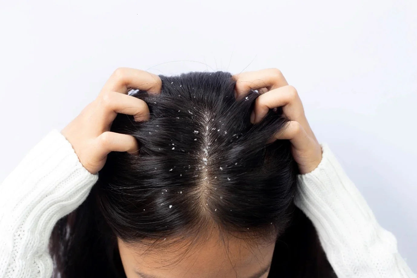 5 Tips for Controlling Dandruff: Expert Advice