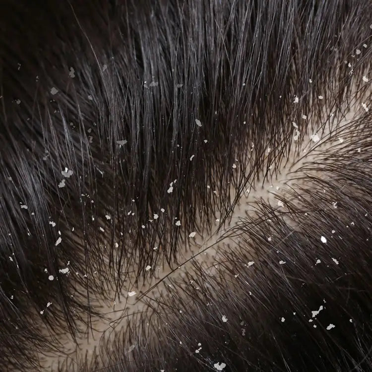 Dandruff