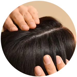 Dandruff & Hairfall