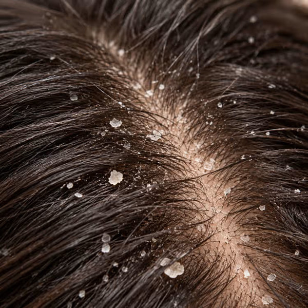 Dandruff