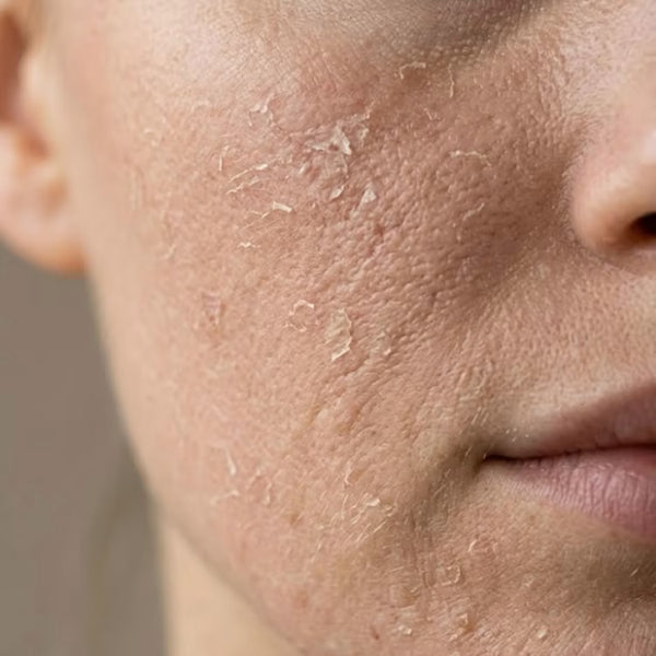 Dry Skin