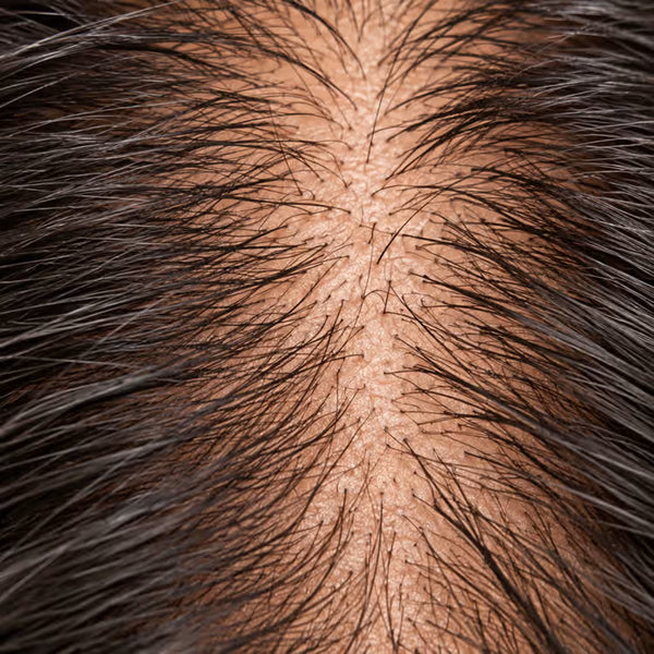 Hair Fall